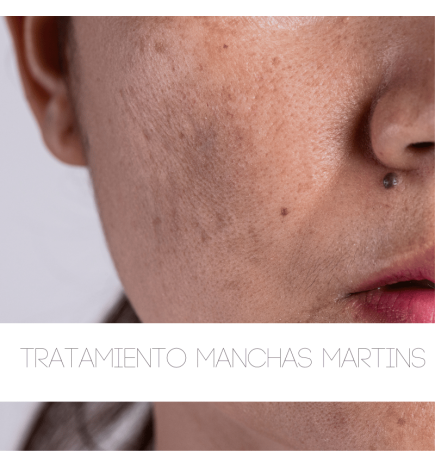 Tratamiento Manchas Martins