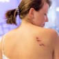 Eliminación de Tatuajes en Burgos