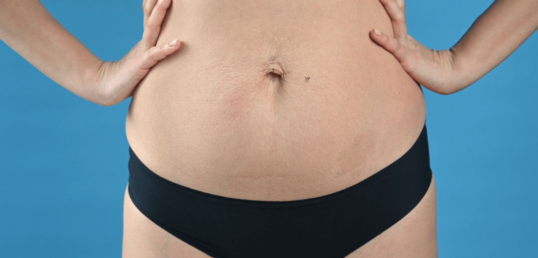 ¿Y si lo que no baja no es grasa, sino diástasis abdominal?